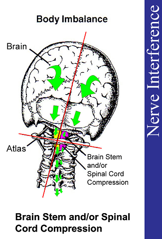 upper cervical chiropractic