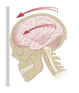 Migraine, Headache, Whiplash, Neck Injury, Accident