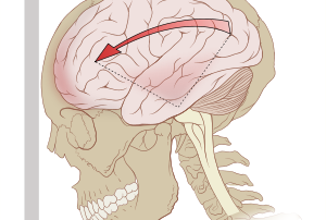 Concussion, Head Trauma, Headache, Head Pain, Post-Concussion Syndrome, Post Concussion Syndrome