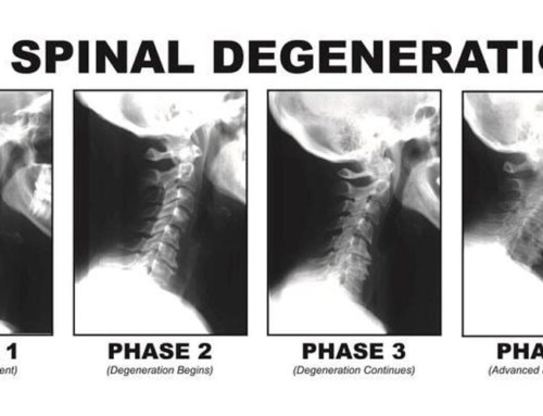 Is Your Neck Causing Your Carpal Tunnel Syndrome? - NUCCA Wellness ...