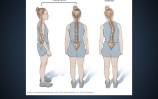 scoliosis, nucca chiropractor, children