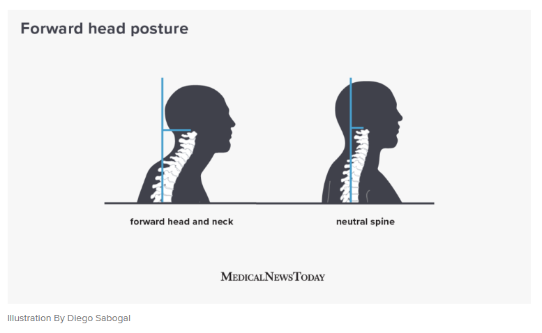 forward head posture by medicalnewstoday